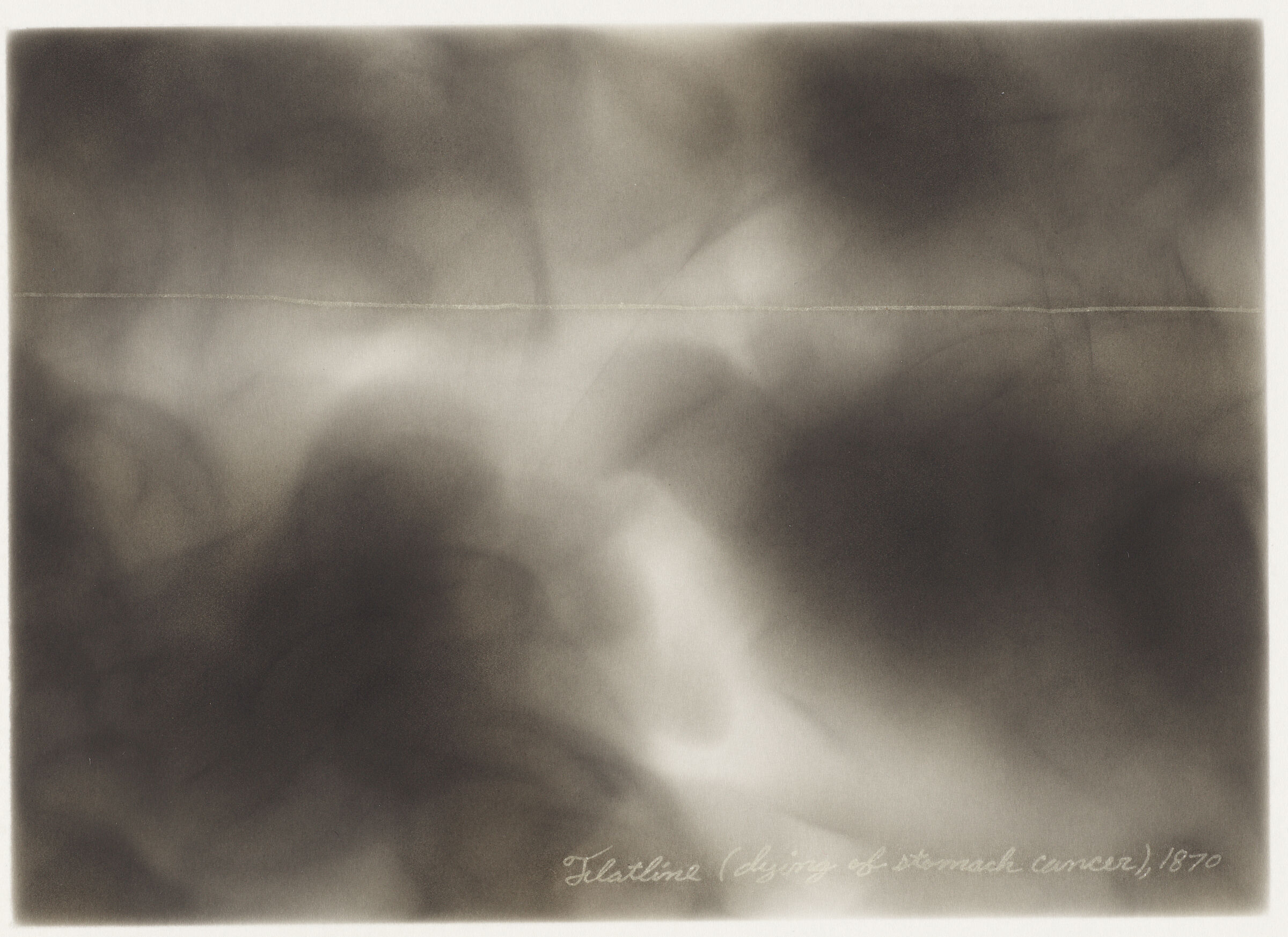 Flatline (Dying Of Stomach Cancer), 1870
